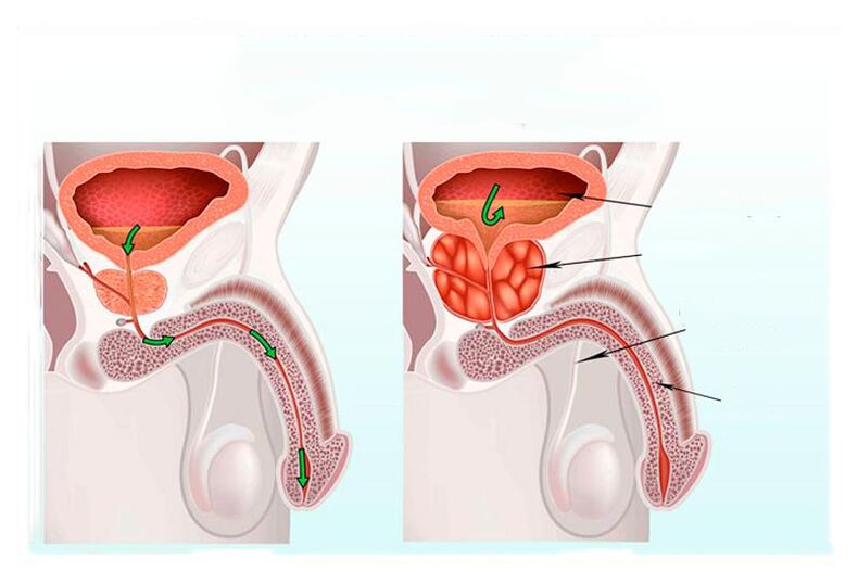 Norma and inflammation of prostate glands